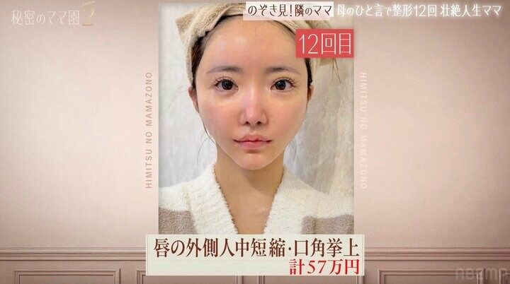 【写真・画像】「整形総額1000万円」19歳から12回繰り返した“顔面課金”の全記録「顔の骨を削り、鼻をフル整形」34歳美女が“お人形フェイス”を手に入れるまで 2枚目