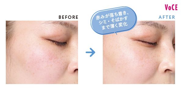 BEFORE AFTER 赤みが落ち着き、シミ・そばかすまで薄く変化