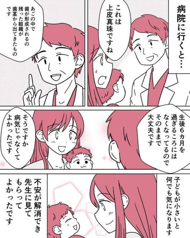上皮真珠 体験談マンガ化