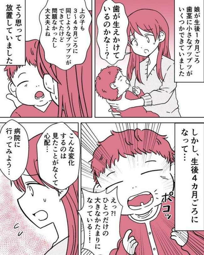 上皮真珠 体験談マンガ化