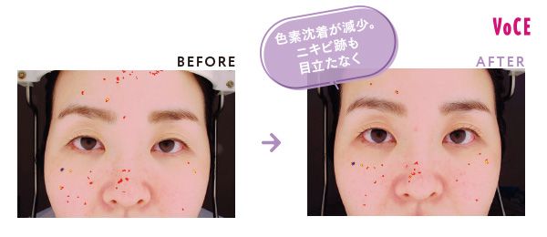 BEFORE AFTER 色素沈着が減少。ニキビ跡も目立たなく