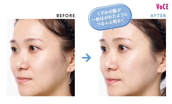 BEFORE AFTER くすみの膜が一枚はがれたようにつるんと明るく