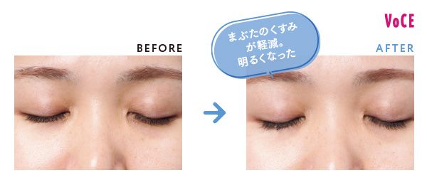 BEFORE AFTER まぶたのくすみが軽減。明るくなった