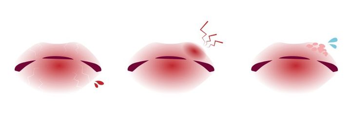 口唇ヘルペスと唇のトラブルのイラスト リップケア