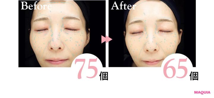 2026年おすすめブライトニング最新作 ポーラ ホワイトショット クリアスキンローション 使用後の表面シミの変化