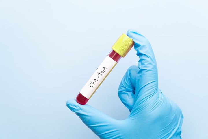 「腫瘍マーカー」はがんを発見する手掛かりになる？（画像はイメージ）