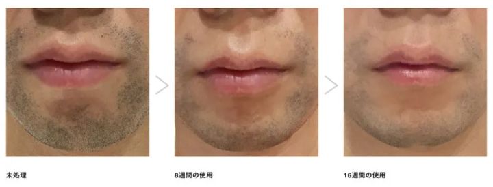 男性の顎ひげ脱毛ビフォーアフター