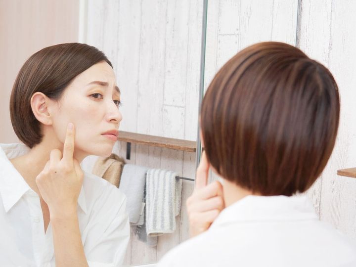 【薬学部教授が解説】「肝斑」ができるのは、女性ホルモンや紫外線が原因です。治療の主軸となるトラネキサム酸の実際の効果と、止血作用による副作用のリスクと注意点について、分かりやすく解説します。（※画像：Shutterstock.com）