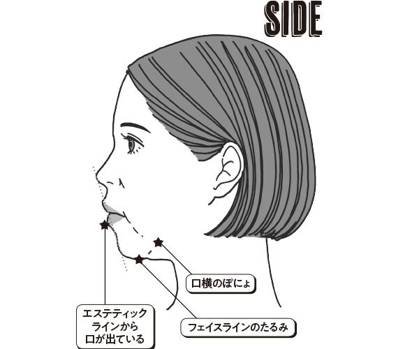 SIDE 口横のぽにょ エステティックラインから口が出ている フェイスラインのたるみ
