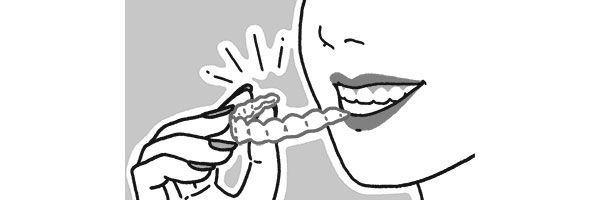 マウスピース矯正