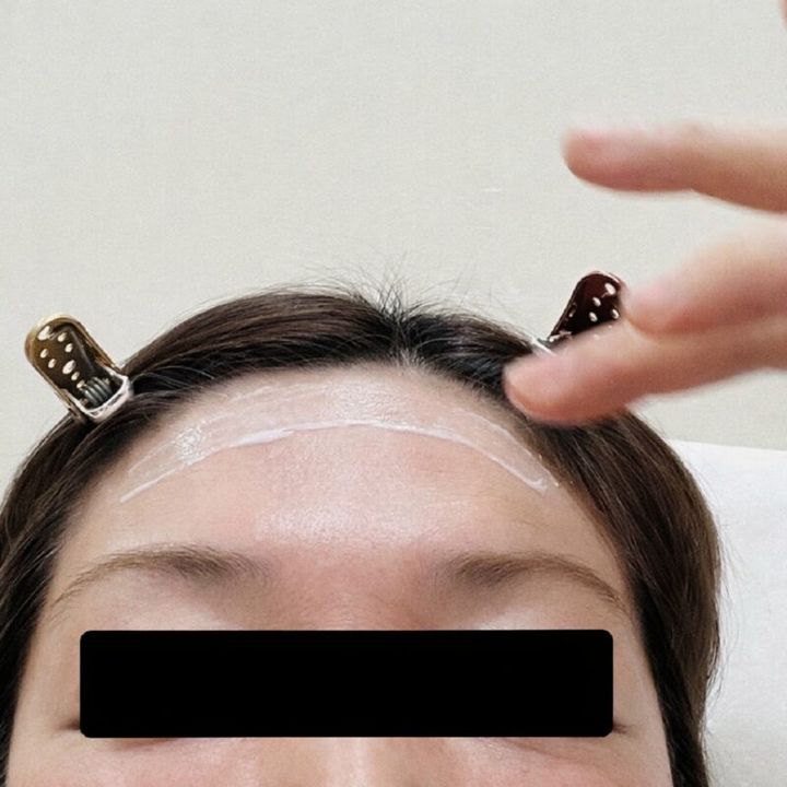 麻酔クリームをたっぷり塗ります