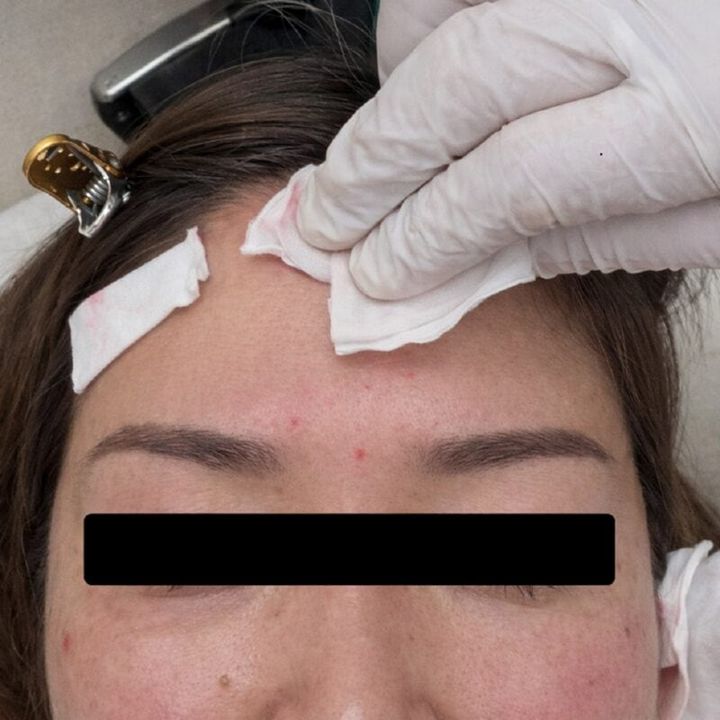 注射直後はすぐにコットンで止血