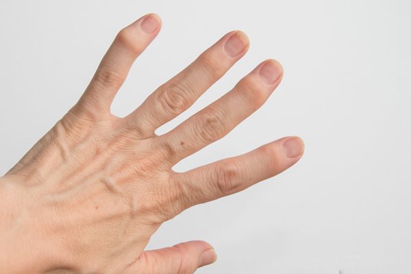 「その指、いったいどうしたの？」と聞かれるのがつらい......