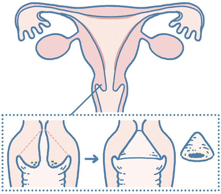 Q. 子宮頸部高度異形成ってどんな手術を行うの？