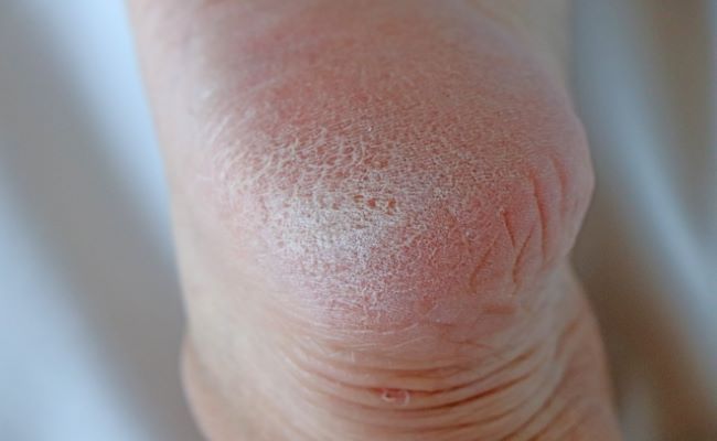 ガサガサかかと