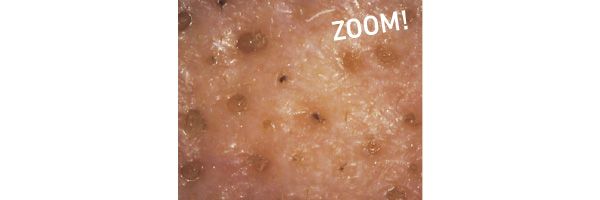 黒ずみ・つまり毛穴悩みは……／ZOOM！