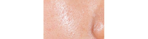 皮脂毛穴悩みは……