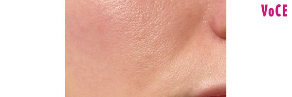 炎症または血管拡張などによる【赤】