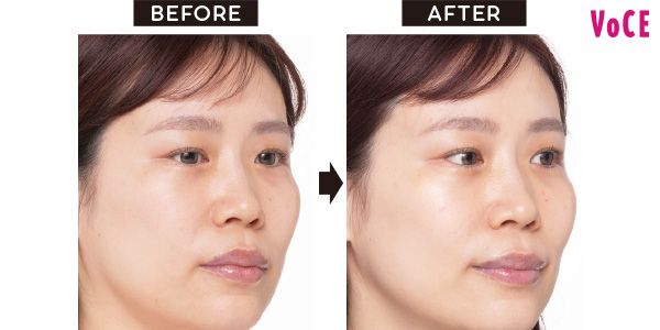 VOCEアンバサダー Rieさんの BEFORE→AFTER