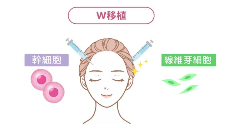 W移植治療の仕組みを説明したイラスト図解。女性の顔に左右から注射器を当て、幹細胞と線維芽細胞を同時注入することを視覚化した施術概念図