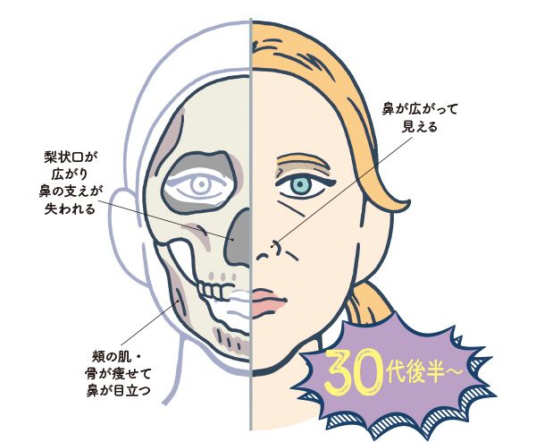30代後半～ 鼻が広がって見える 梨状口が広がり鼻の支えが失われる 頰の肌・骨が痩せて鼻が目立つ