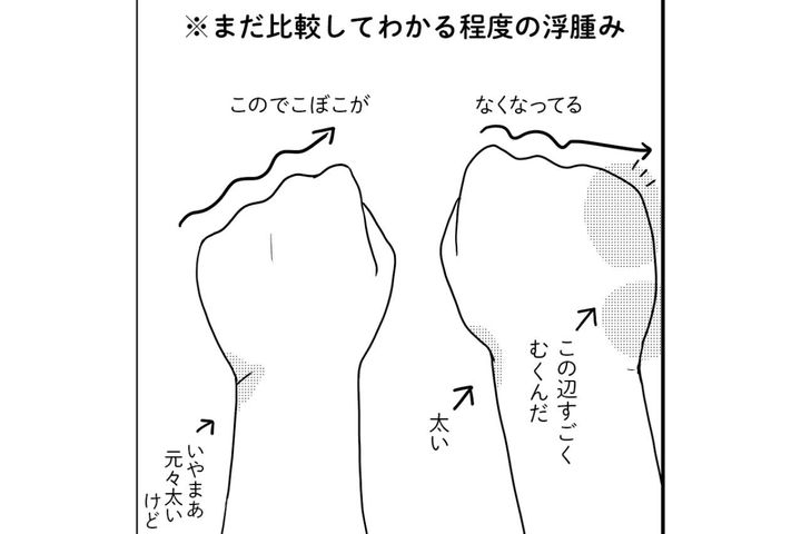 リンパ浮腫に…むくみを和らげるために必要だったこと【乳癌日記 #51】
