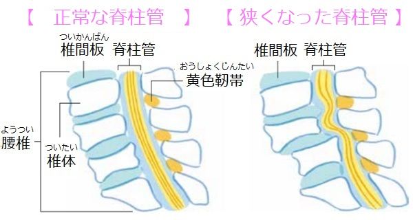 脊柱管 比較イラスト