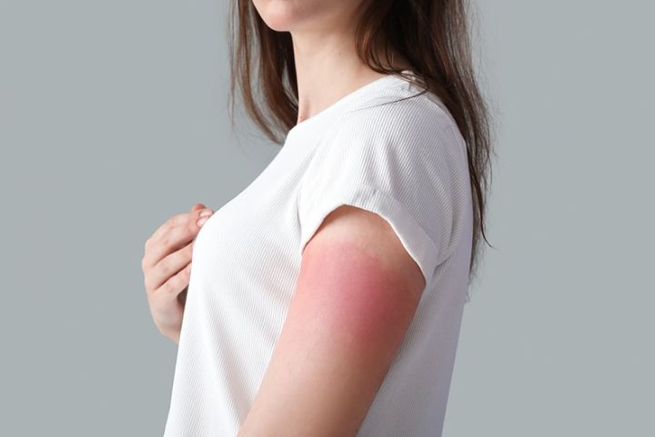 日焼けして腕が赤い女性