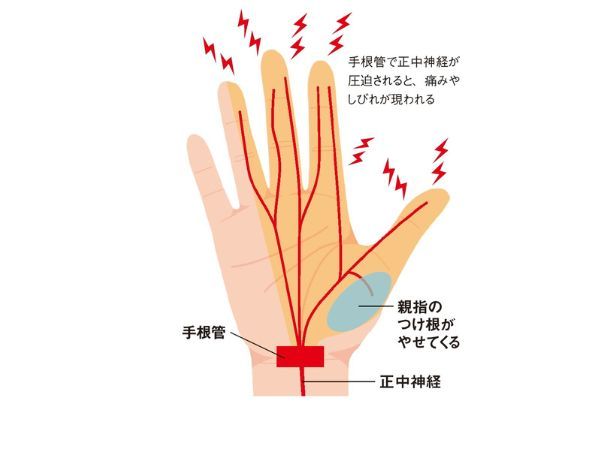 手指の病気3「手根管症候群」