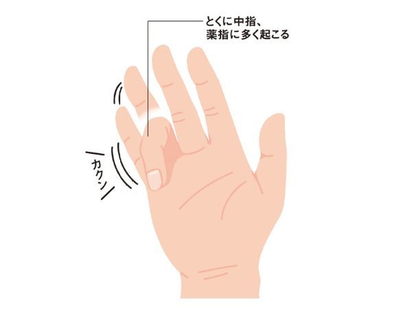 手指の病気1「ばね指」