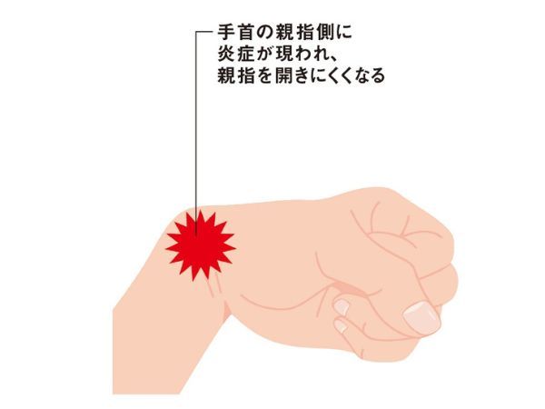 手指の病気2「ドケルバン病」