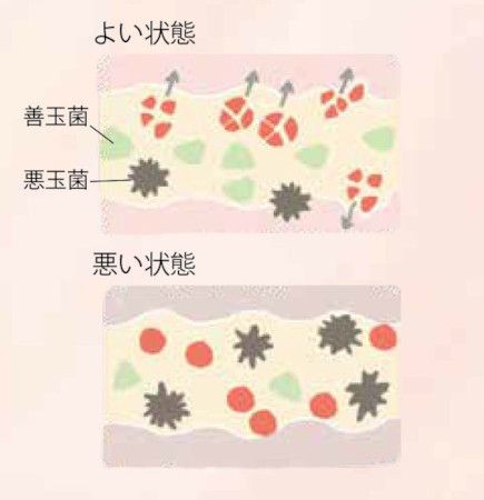 腸内環境の悪化