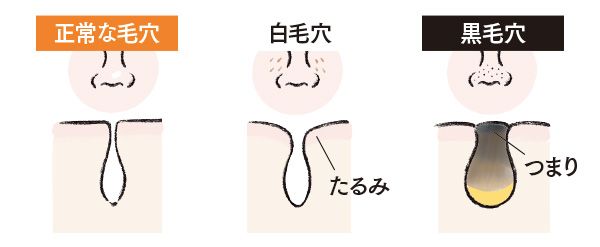 正常な毛穴、白毛穴、黒毛穴
