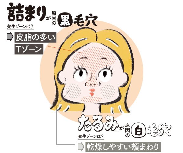 詰まりが原因の黒毛穴、たるみが原因の白毛穴