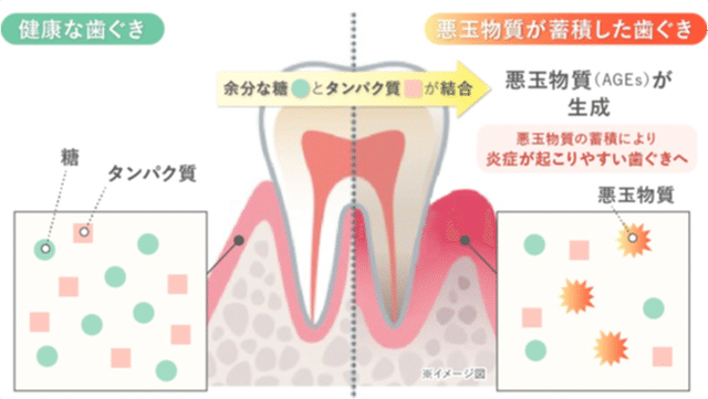 悪玉物質「AGEs（終末糖化産物）」が蓄積した歯ぐき