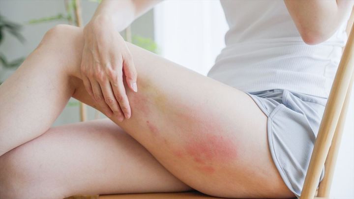 肌の「赤いぷつぷつ」実は「あせも」じゃないかも…