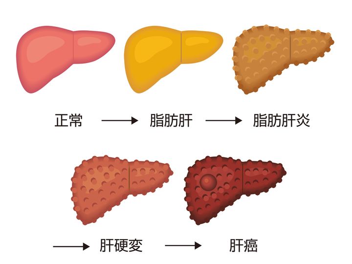 脂肪肝