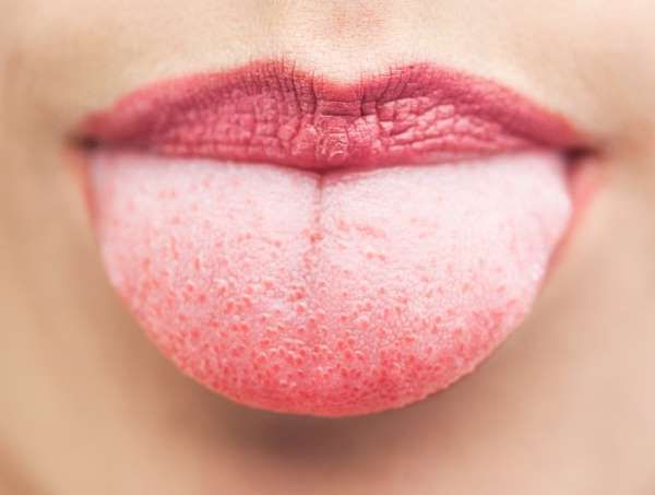 口臭舌苔