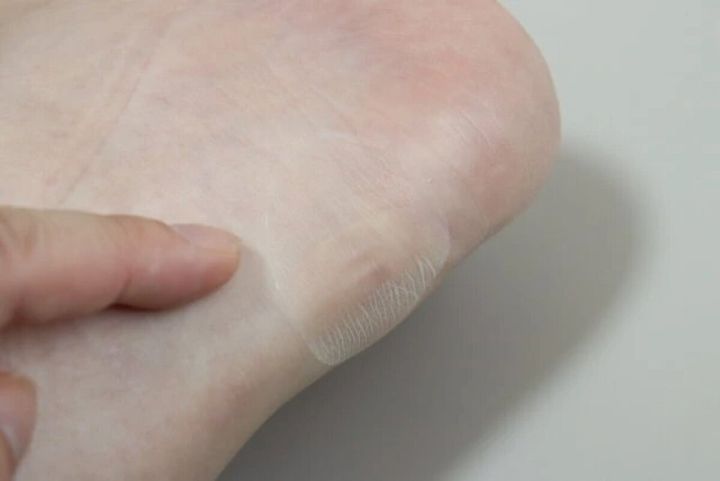 足のかかとに透明な靴ずれ防止シールを貼る様子