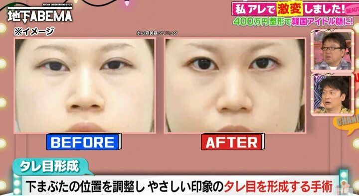 【写真・画像】まぶたを開く筋肉の働きを調整し目を開きやすく…人気の整形「目つき矯正」に驚きの声「そんなことしていいの！？」 2枚目