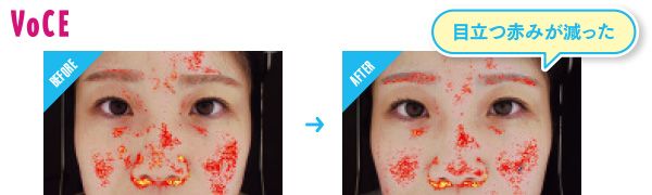 BEFORE→AFTER 目立つ赤みが減った