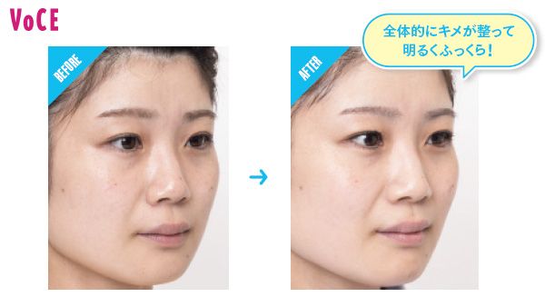BEFORE→AFTER 全体的にキメが整って明るくふっくら！