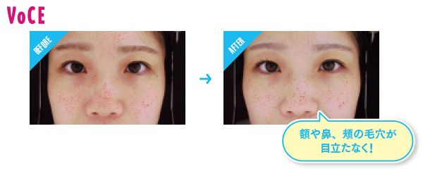 BEFORE→AFTER 額や鼻、頰の毛穴が目立たなく！