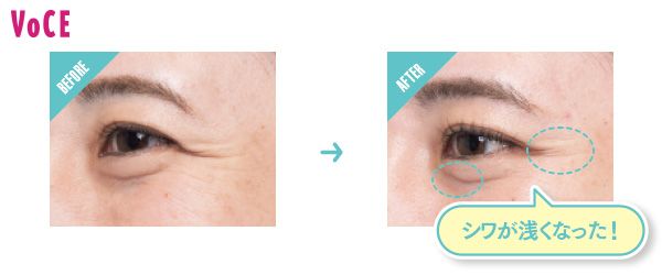 BEFORE→AFTER シワが浅くなった！