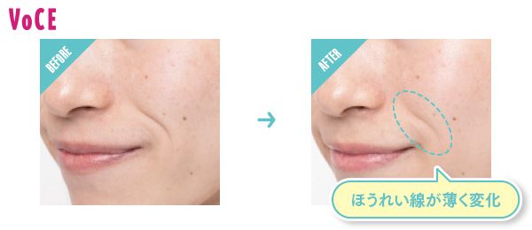 BEFORE→AFTER ほうれい線が薄く変化