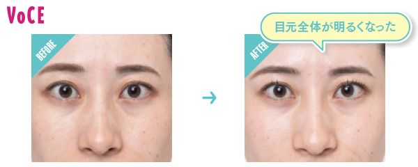 BEFORE→AFTER 目元全体が明るくなった