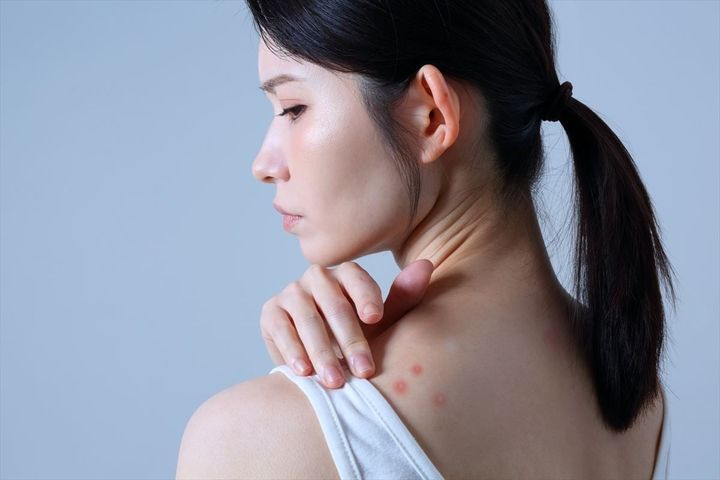 ニキビだと思ったら「粉瘤」だった！どうすればよい？（画像はイメージです）