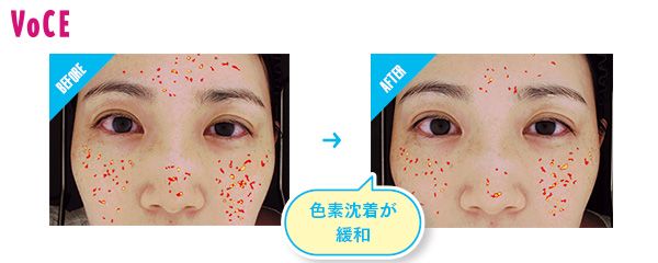 BEFORE→AFTER 色素沈着が緩和