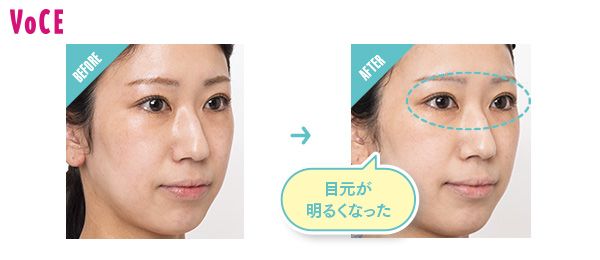 BEFORE→AFTER 目元が明るくなった