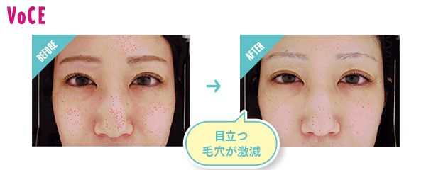 BEFORE→AFTER 目立つ毛穴が激減